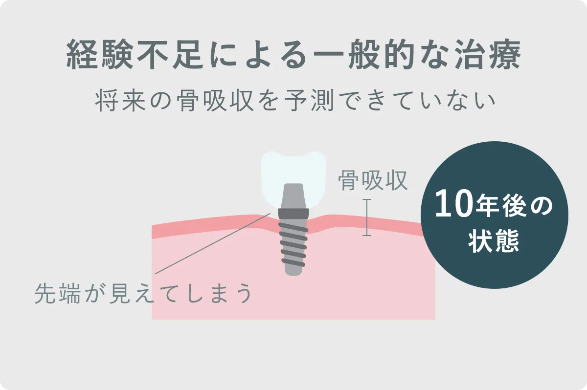 埋入ポジションのシミュレーション画像 1