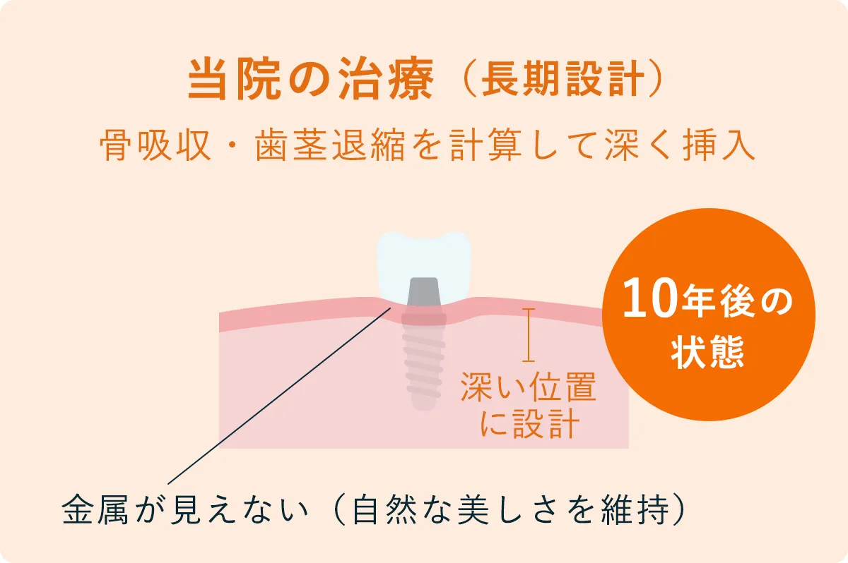 埋入ポジションのシミュレーション画像 2